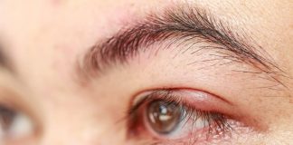 korekcia očných viečok