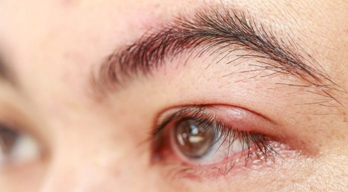 korekcia očných viečok